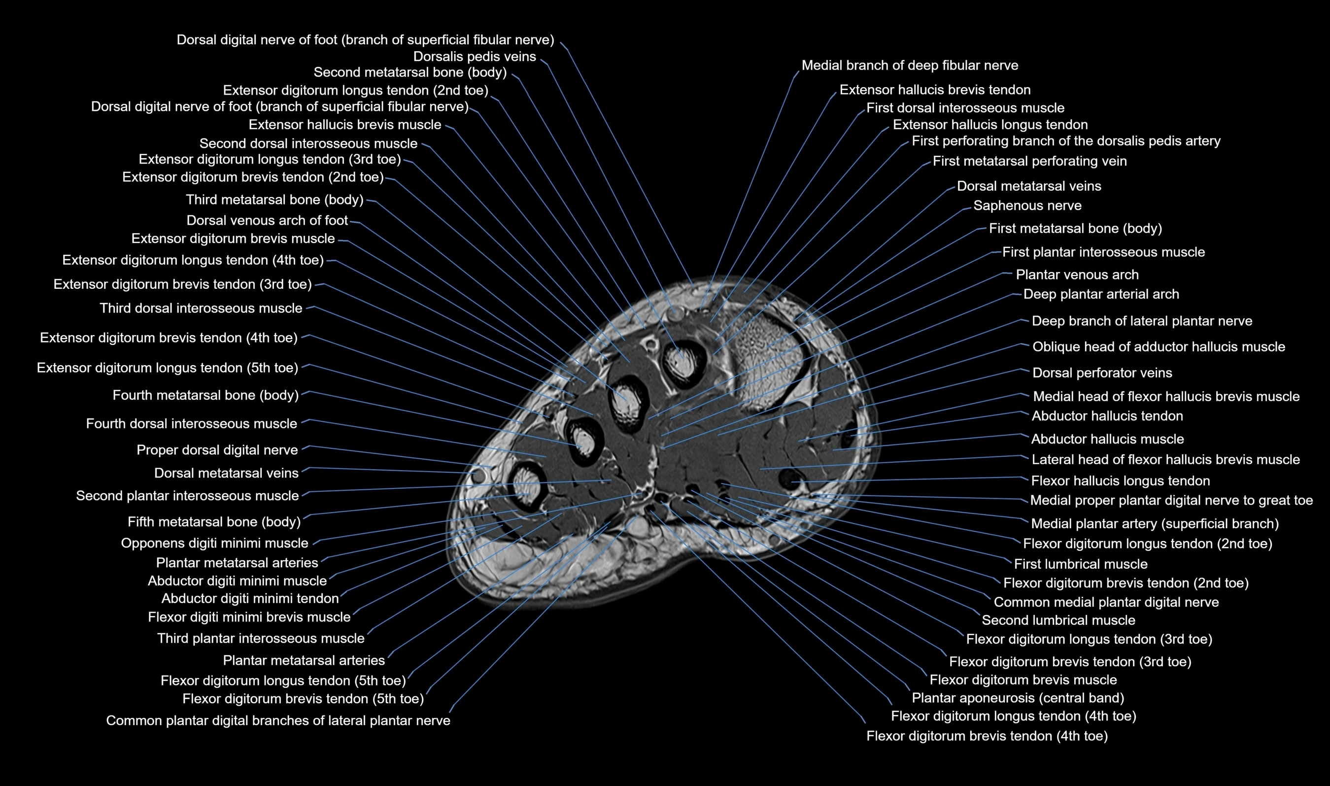 MRI mid foot axial cross sectional anatomy 3T  radiology  image-img-00001-00006.webp